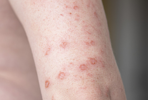 body-with-allergic-rash